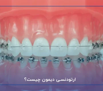 ارتودنسی دیمون چیست؟