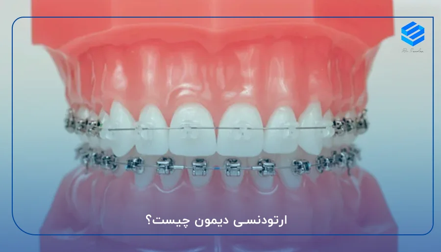 ارتودنسی دیمون چیست؟