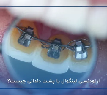 ارتودنسی لینگوال یا پشت دندانی چیست؟