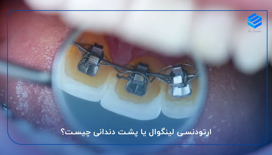 ارتودنسی لینگوال یا پشت دندانی چیست؟