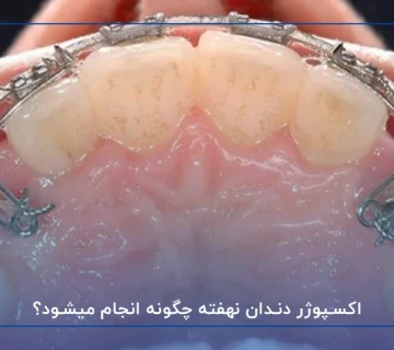 اکسپوژر دندان نهفته چگونه انجام میشود؟