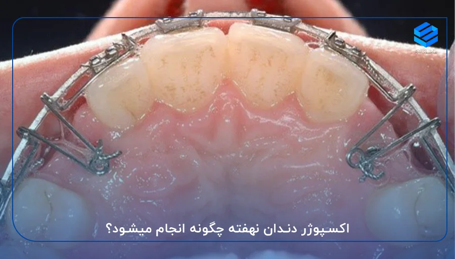 اکسپوژر دندان نهفته چگونه انجام میشود؟