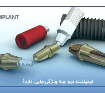 ایمپلنت دیو چه ویژگی‌هایی دارد؟