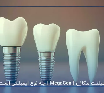 ایمپلنت مگاژن [ MegaGen ] چه نوع ایمپلنتی است؟