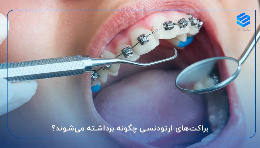 براکت‌های ارتودنسی چگونه برداشته می‌شوند؟