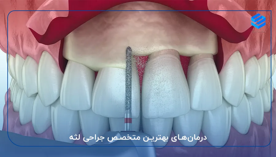 درمان‌های بهترین متخصص جراحی لثه 