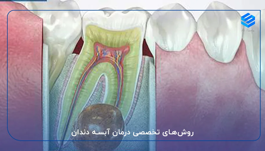 روش‌های تخصصی درمان آبسه دندان