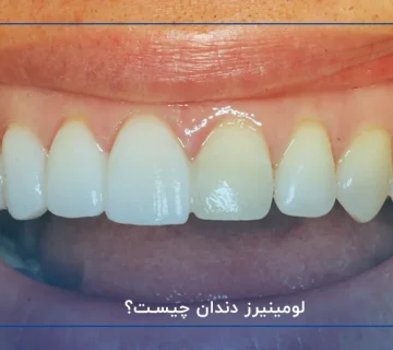 لومینیرز دندان چیست؟