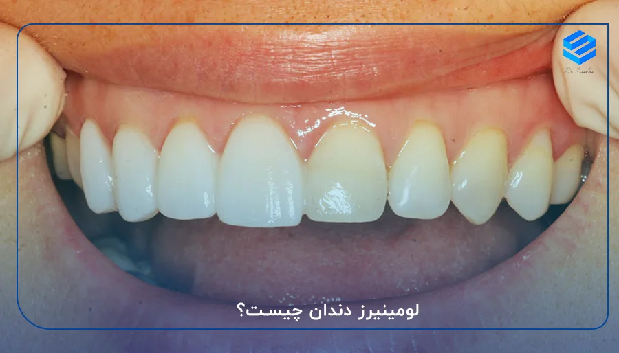 لومینیرز دندان چیست؟