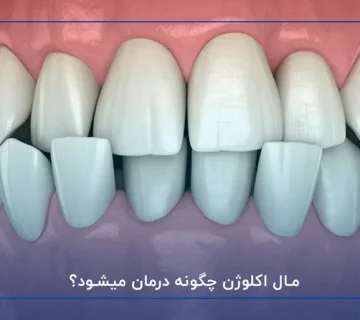 مال اکلوژن چگونه درمان میشود؟
