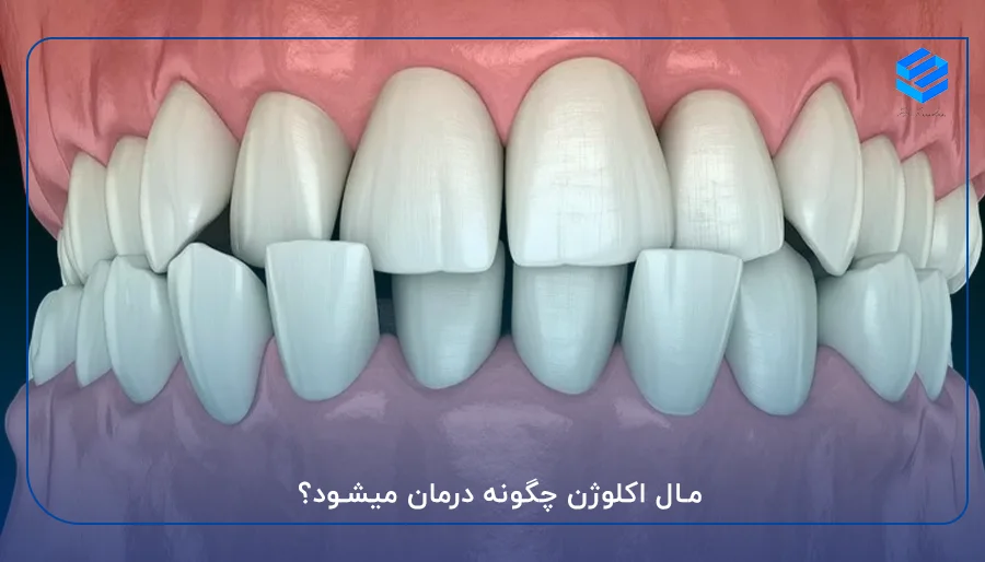 مال اکلوژن چگونه درمان میشود؟