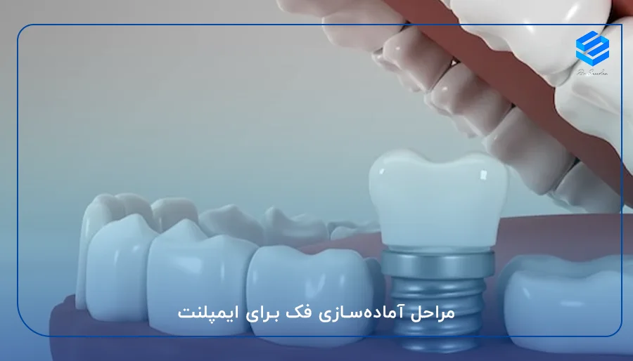 مراحل آماده‌سازی فک برای ایمپلنت