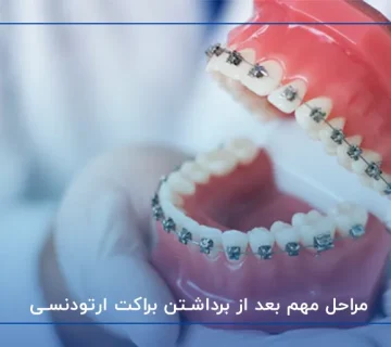 مراحل مهم بعد از برداشتن براکت ارتودنسی