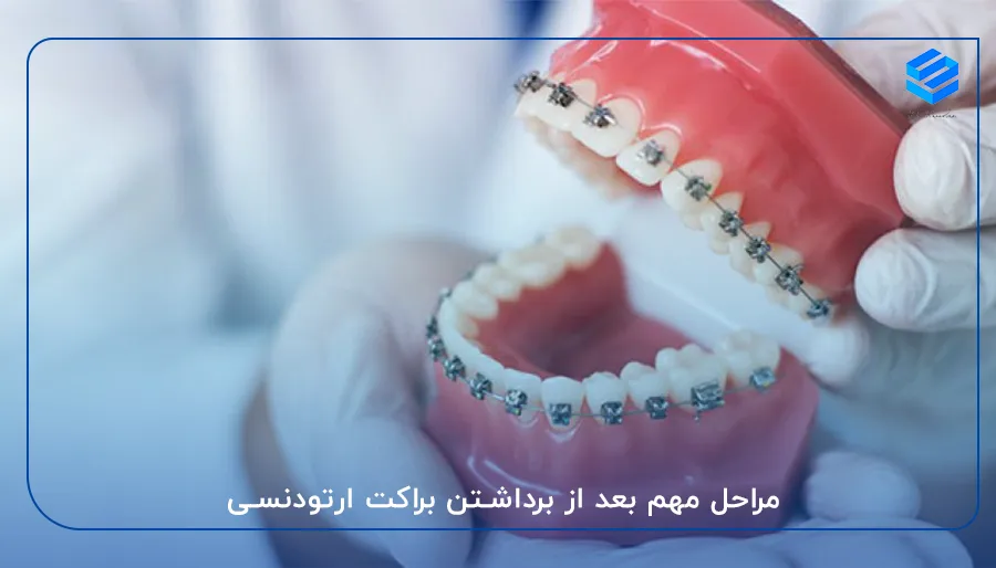 مراحل مهم بعد از برداشتن براکت ارتودنسی