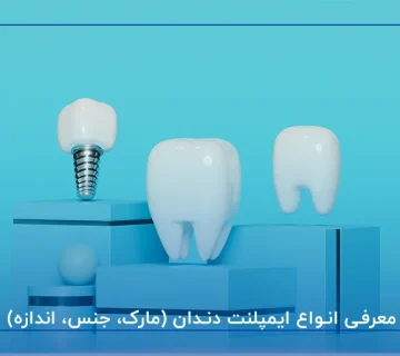 معرفی انواع ایمپلنت دندان (مارک، جنس، اندازه)