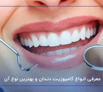 معرفی انواع کامپوزیت دندان و بهترین نوع آن