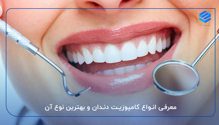 معرفی انواع کامپوزیت دندان و بهترین نوع آن