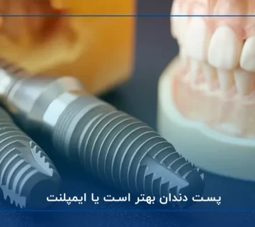 پست دندان بهتر است یا ایمپلنت