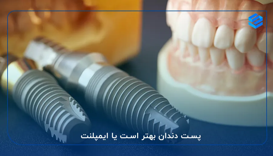 پست دندان بهتر است یا ایمپلنت
