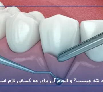 پیوند لثه چیست؟ و انجام آن برای چه کسانی لازم است؟