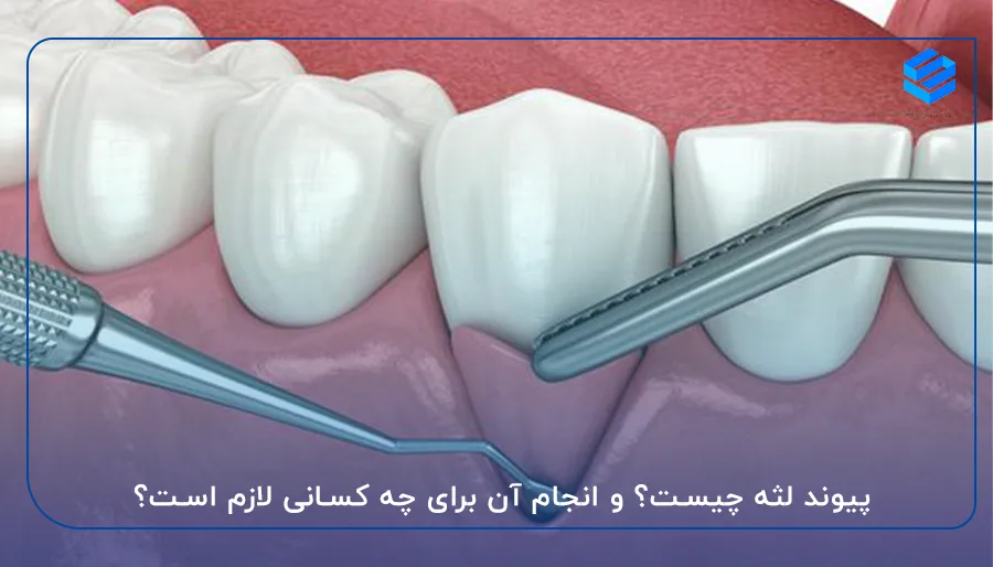 پیوند لثه چیست؟ و انجام آن برای چه کسانی لازم است؟