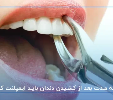 چه مدت بعد از کشیدن دندان باید ایمپلنت کرد