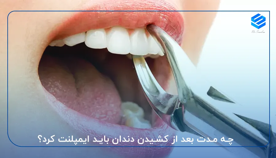 چه مدت بعد از کشیدن دندان باید ایمپلنت کرد