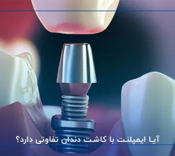 آیا ایمپلنت با کاشت دندان تفاوتی دارد؟