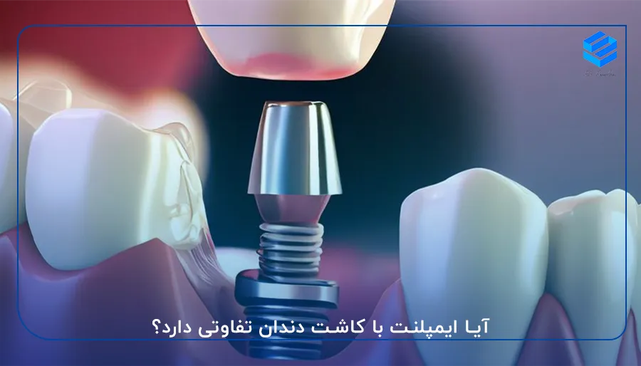 آیا ایمپلنت با کاشت دندان تفاوتی دارد؟