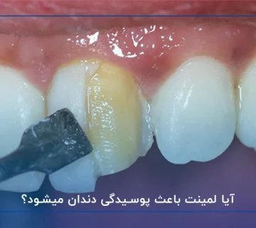 آیا لمینت باعث پوسیدگی دندان میشود؟