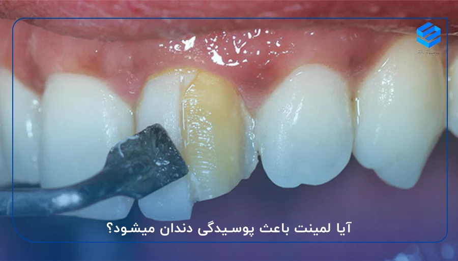 آیا لمینت باعث پوسیدگی دندان میشود؟