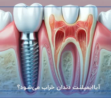 آیاایمپلنت دندان خراب می‌شود