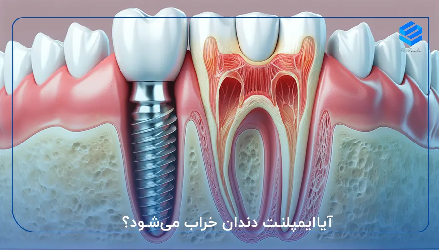 آیاایمپلنت دندان خراب می‌شود