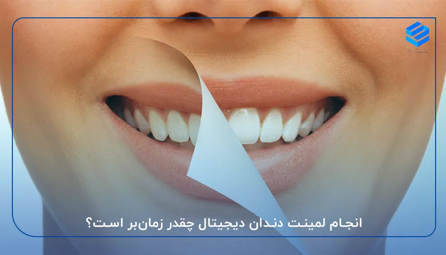 انجام لمینت دندان چقدر زمان‌بر است؟