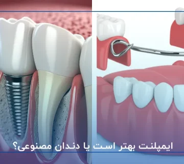 ایمپلنت بهتر است یا دندان مصنوعی؟