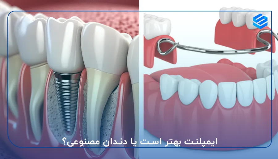 ایمپلنت بهتر است یا دندان مصنوعی؟
