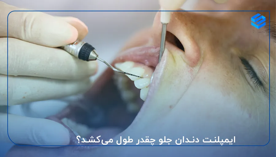 ایمپلنت دندان جلو چقدر طول می‌کشد