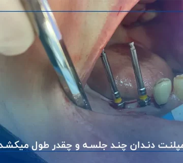 ایمپلنت دندان چند جلسه و چقدر طول میکشد