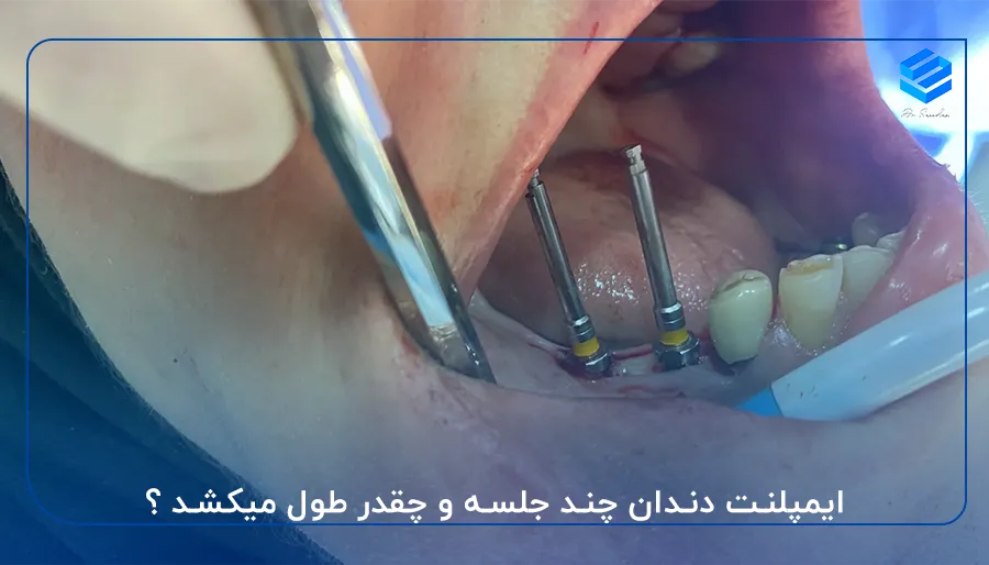 ایمپلنت دندان چند جلسه و چقدر طول میکشد