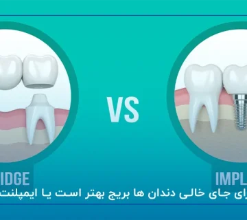 برای جای خالی دندان ها بریج بهتر است یا ایمپلنت؟