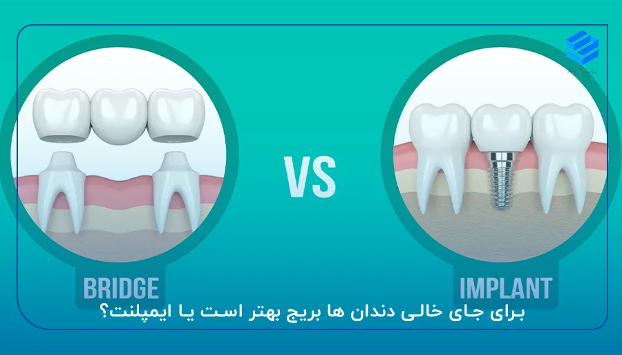برای جای خالی دندان ها بریج بهتر است یا ایمپلنت؟