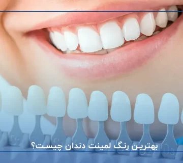 بهترین رنگ لمینت دندان چیست