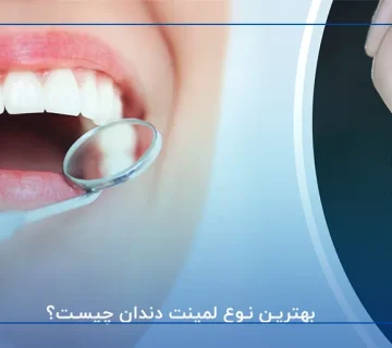بهترین نوع لمینت دندان چیست؟