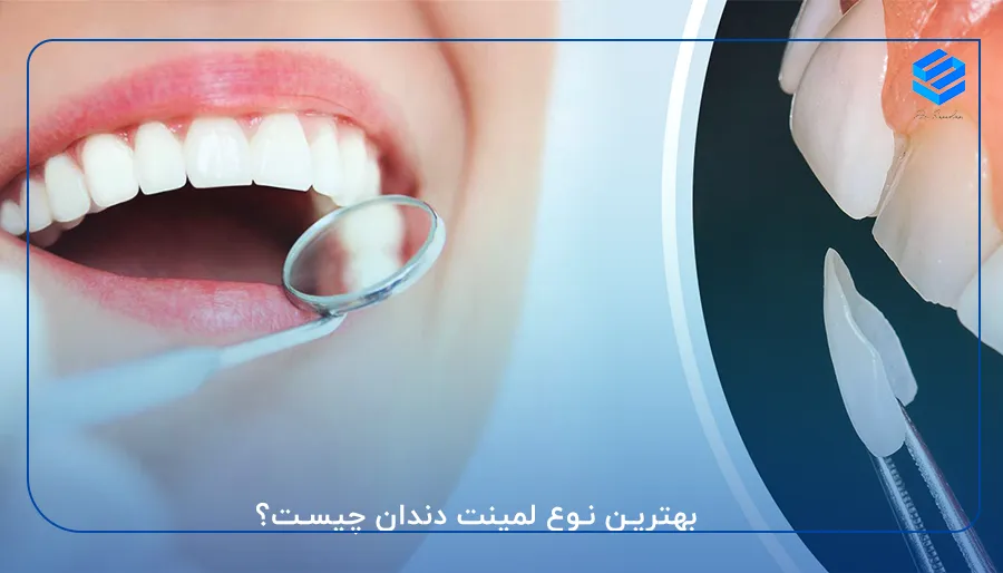 بهترین نوع لمینت دندان چیست؟