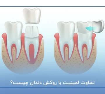 تفاوت لمینیت با روکش دندان چیست؟