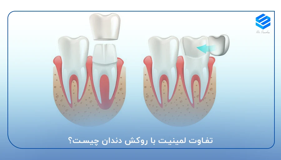 تفاوت لمینیت با روکش دندان چیست؟
