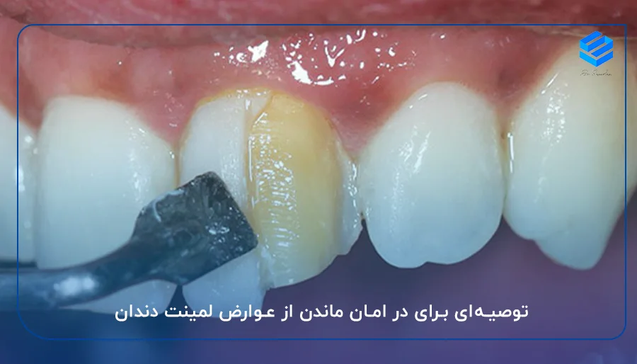 توصیه‌‌ای برای در امان ماندن از عوارض لمینت دندان