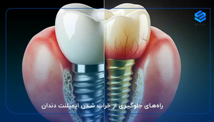 راه‌های جلوگیری از خراب شدن ایمپلنت دندان
