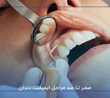 صفر تا صد مراحل ایمپلنت دندان