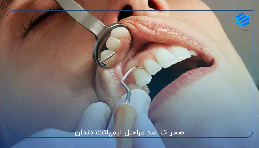 صفر تا صد مراحل ایمپلنت دندان